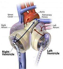 Artificial Heart