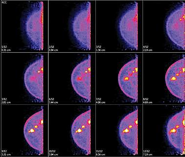 Molecular Breast Imaging