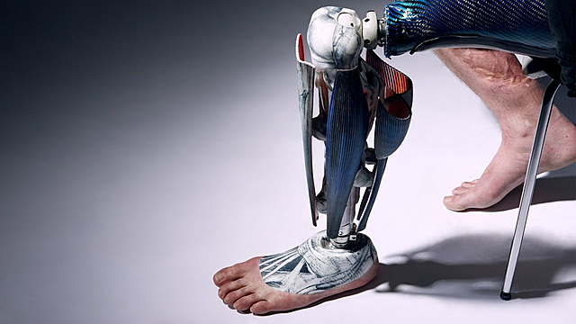 Bionic Prosthetics