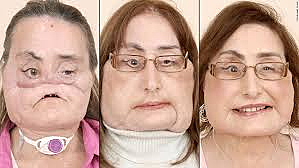 Facial Transplant