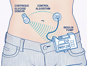 Artificial Pancreas