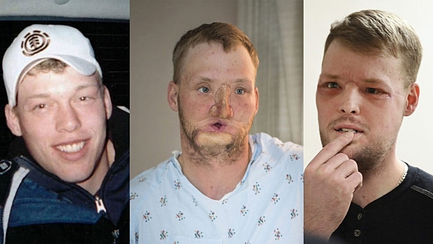 Facial Transplant