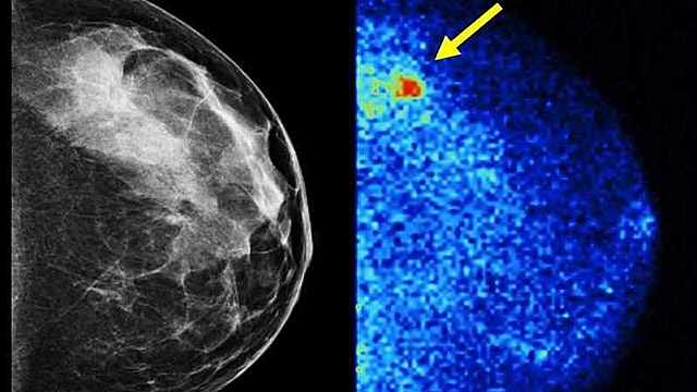 Molecular Breast imaging