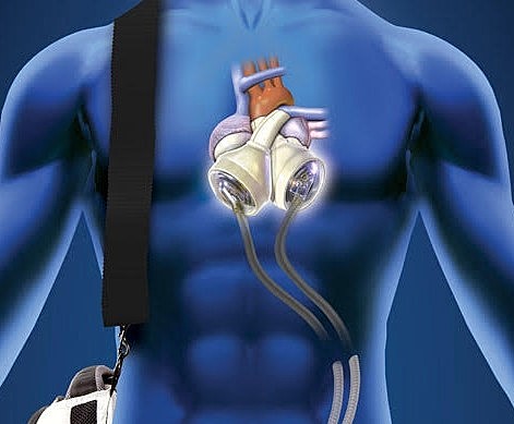 Artificial Heart