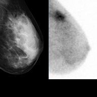 Molecular Breast Imaging