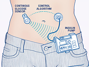 Artificial Pancreas
