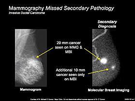 Molecular Breast Imaging