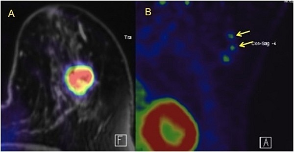 Molecular Breast Imaging