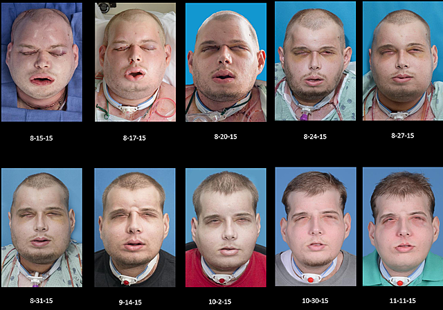 Facial Transplant