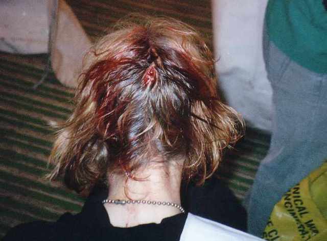 Cracked My Head Open On A Bed