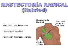 Preservando Tú Vida. Hazte tu autoexamen de mamas a tiempo.