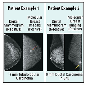 Molecular breast imaging