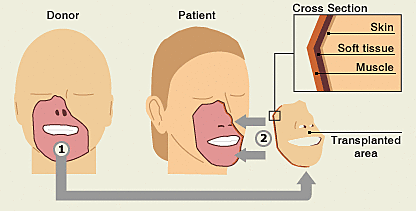 Face Transplant