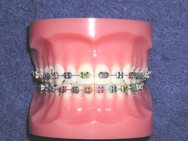 i got braces