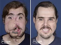 Facial Transplant