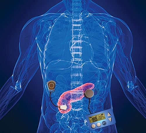 Artificial Pancreas