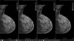 Molecular Breast Imaging
