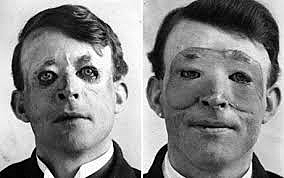 facial transplants