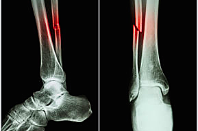 Fractura de tibia y perone