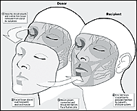 Facial Transplants