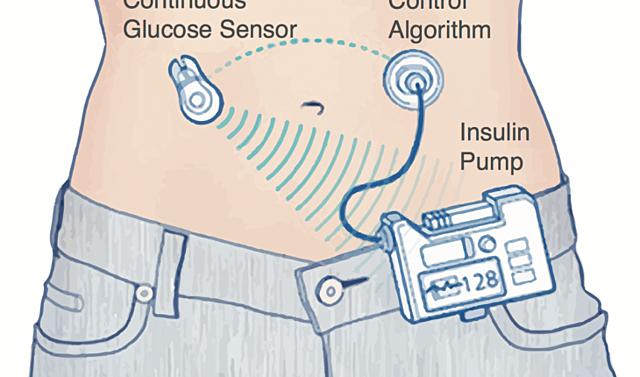 Artificial pancreas