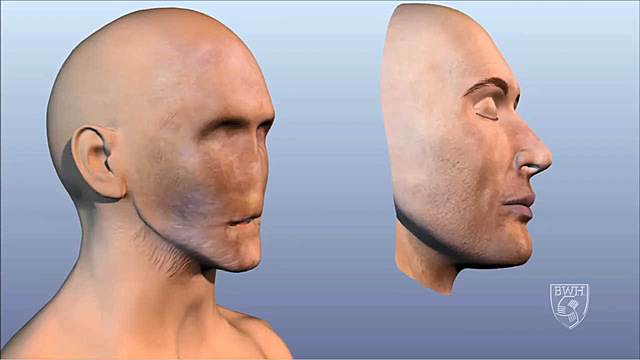 Facial Transplants