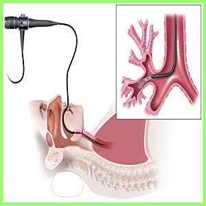 Termoplastía bronquial ***