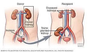 Kidney transplant