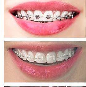 cuando se me callo un diente