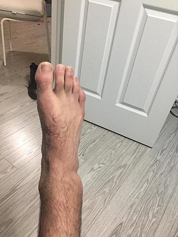 Fractured Ankle