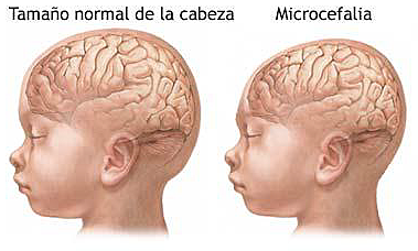 TRANSTORNOS POR EL CIERRE DEL TUBO NEURAL EN EL ENCÉFALO