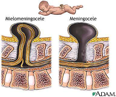 TRANSTORNOS POR EL CIERRE DEL TUBO NEURAL EN LA MÉDULA