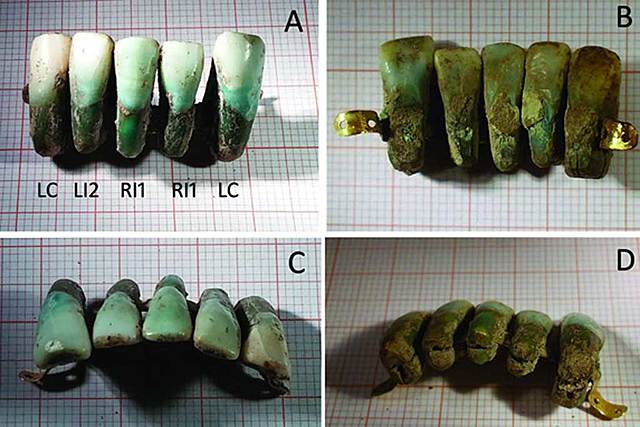 Prótesis dentales en la Edad Media