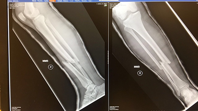 Found out I needed surgery