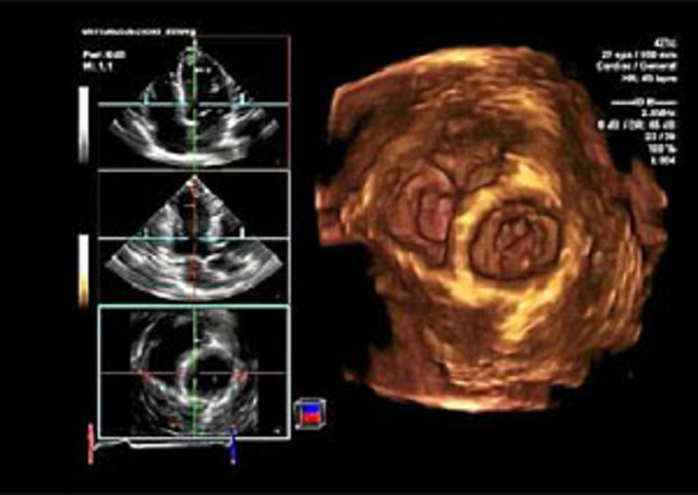 El  Corazón Robot Abio Cor