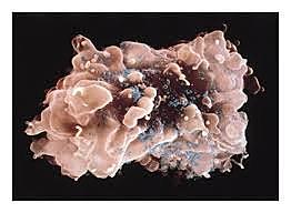 Robert Gallo identified the virus causing AIDS