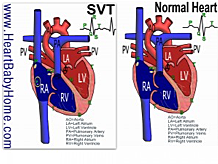 Heart surgery for SVT