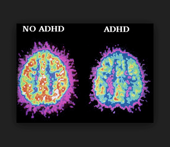 I was diagnosed with ADHD and dysgraphia