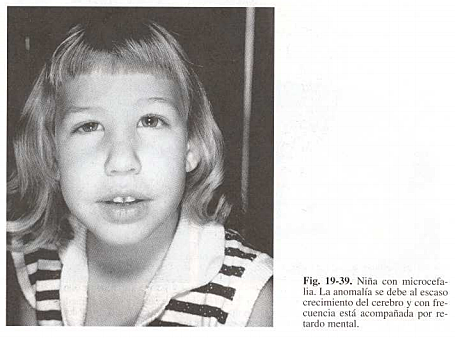 Microcefalia