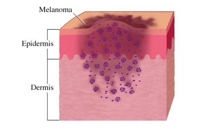 Screening for Skin Cancer