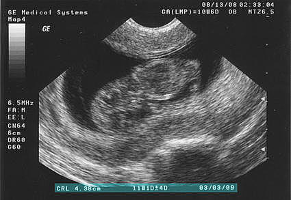 I was going to have a brother