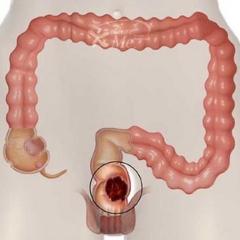 Screeing for Colon Cancer