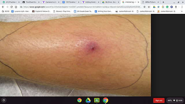 My leg infection