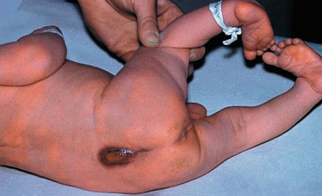 Alteraciones asociadas con defectos del cierre del tubo neural