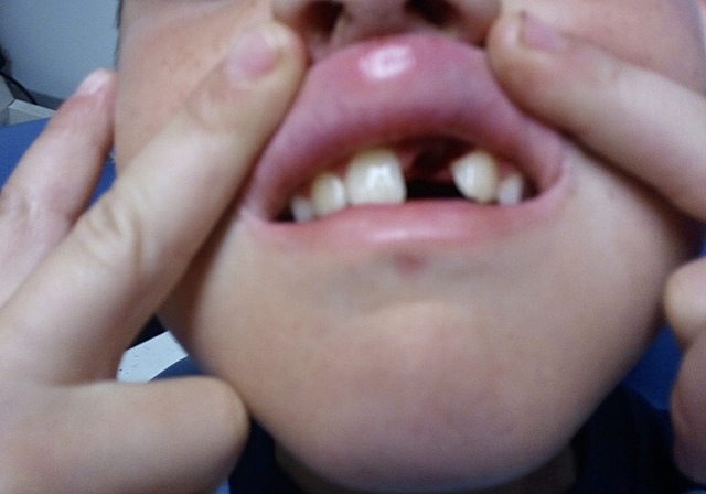 Knocked My Front Tooth Out