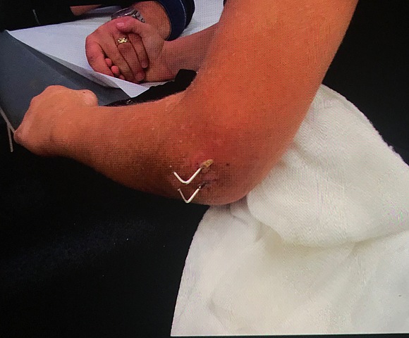 Broken Arm/ Dislocated Elbow