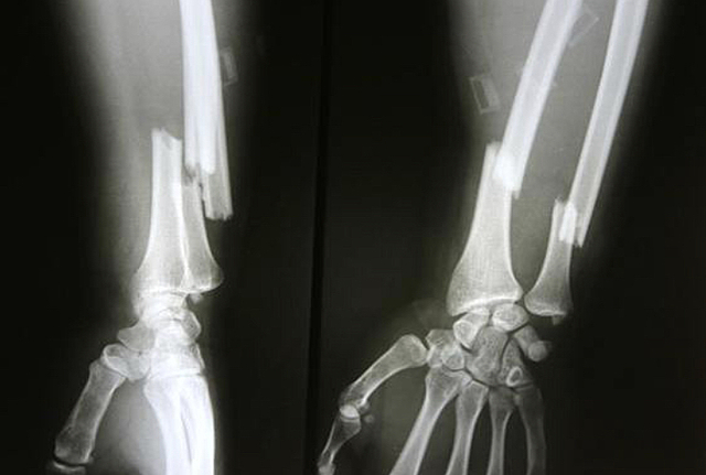 Fracturing my ulna and radius.