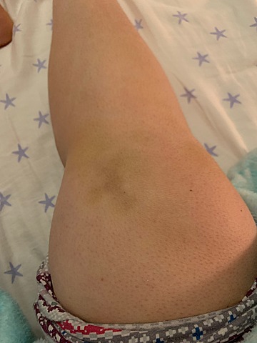 Knee Dislocation (failure)