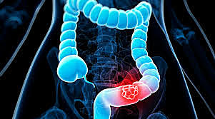Colorectal cancer screening