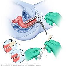 Cervical Cancer Screening - Pap Smear and HPV Test